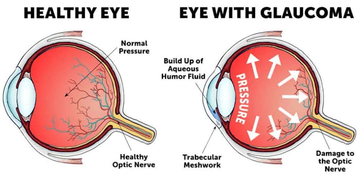Glaucoma management banner